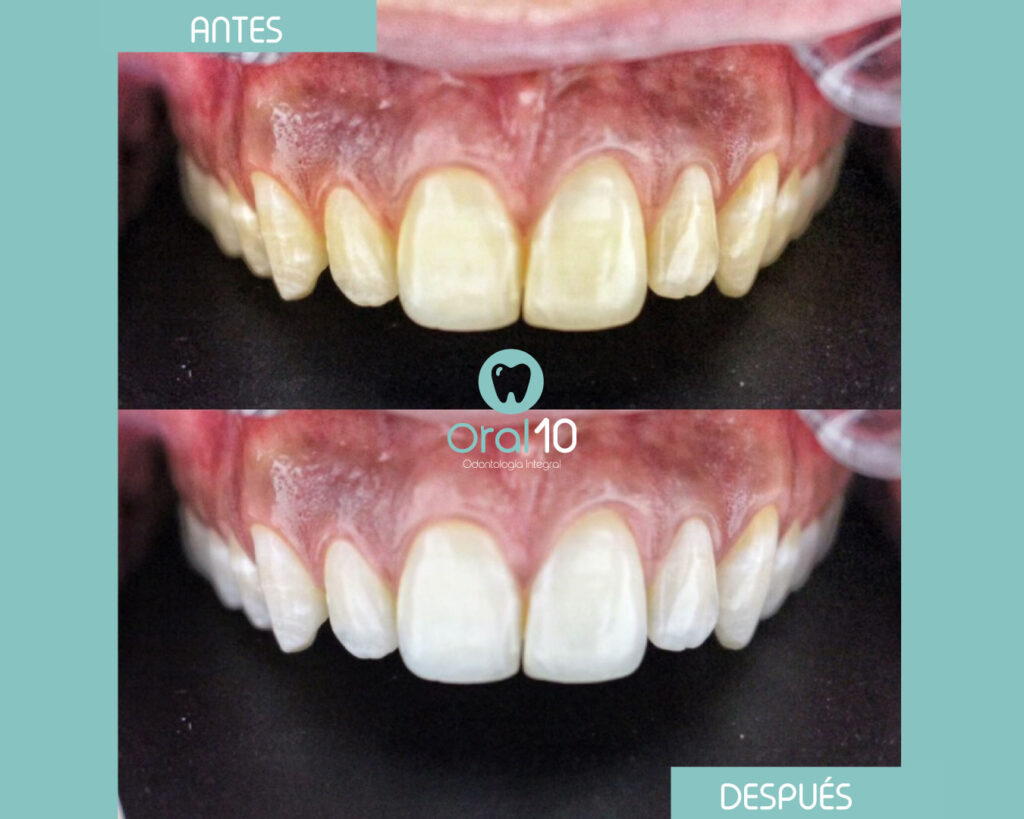 blanqueamiento-dental-en-medellin-el-poblado