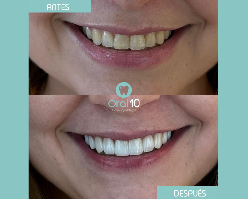 cuanto cuesta un diseño de sonrisa en colombia 2025