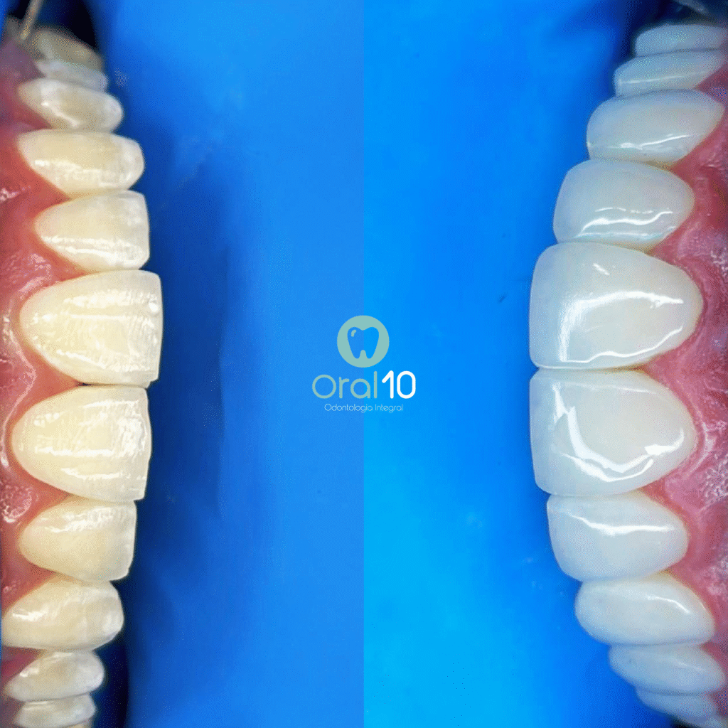 diseño de sonrisa con resina medellin