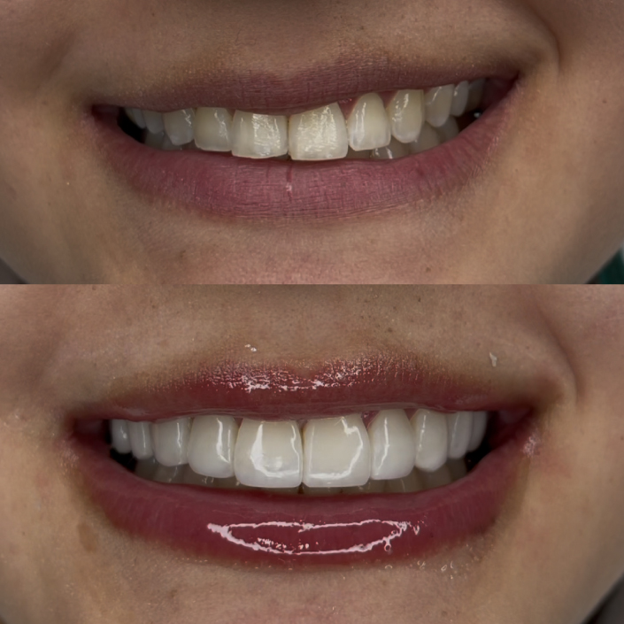 Qué-problemas-corrige-un-diseño-de-sonrisa-Guía-completa